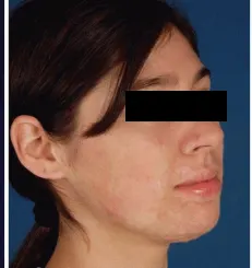 After burn care treatment