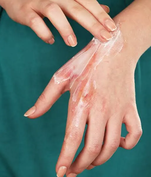 Burn Management & Post Burn Deformity Correction