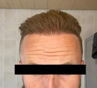 After hair transplant