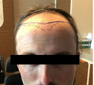 Before hair transplant