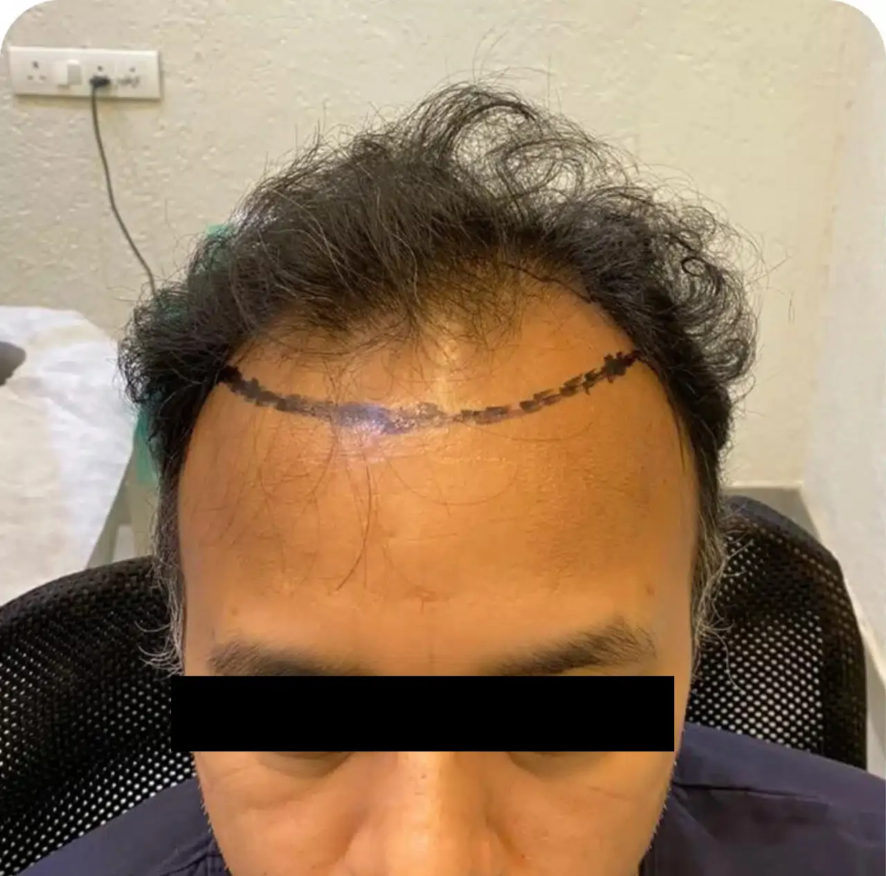 Before hair transplant
