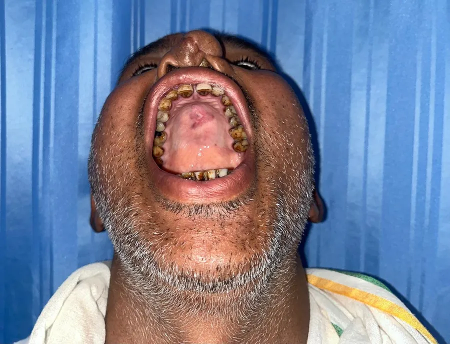 After oral and palate reconstruction