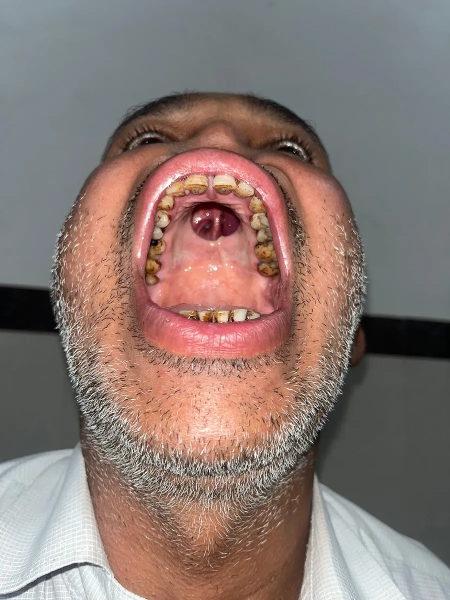 Before oral and palate reconstruction